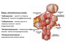 Симптомы миомы матки на ранних стадиях