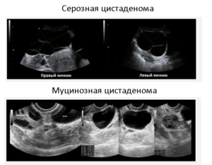 Цистаденома яичника: причины, лечение