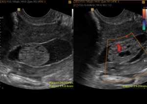 Виден ли на УЗИ рак матки и шейки матки