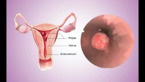 Что такое полипоз эндометрия