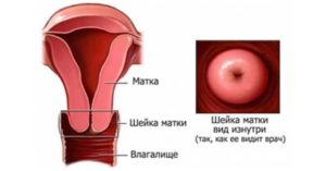 Причины синюшной шейки матки