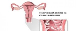 Как можно заразиться молочницей женщине