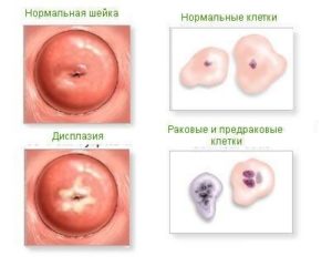 Ампутация шейки матки при 3 степени дисплазии