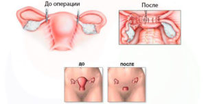 Что происходит с организмом после удаления матки