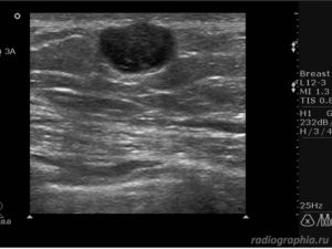 Анэхогенные образования в молочной железе