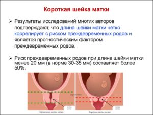 Что значит и чем грозит короткая шейка матки