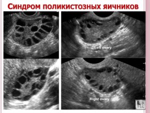 Техника диатермокаутеризация яичников при синдроме поликистозных яичников