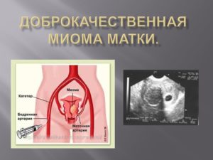 Чем лейомиома матки отличается от миомы