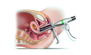 На какой день цикла делается гистероскопия матки