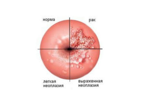 Неоплазия шейки матки