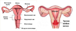 Эрозия шейки матки у женщин