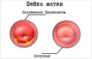 Эндоцервицит при беременности