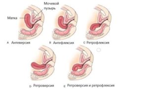 Неправильное расположение матки