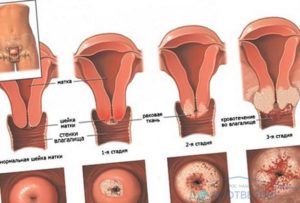 Цервикоз шейки матки что это такое фото