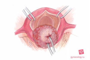 Миома матки после родов