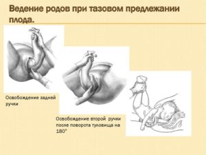 Тазовое предлежание плода на 30 неделе беременности