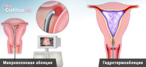 Что такое абляция шейки матки