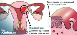 Гиперплазия яичника в менопаузе