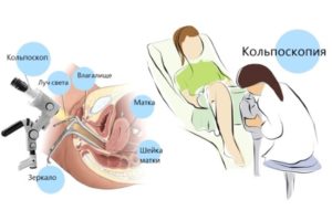 Кольпоскопия шейки матки