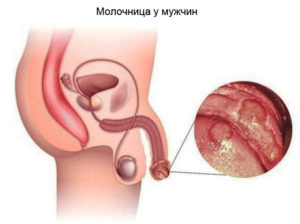 Молочница у мужчин инкубационный период