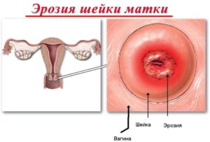 Маленькая эрозия шейки матки