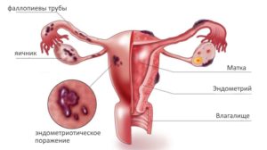 Лечение эндометриоза у женщин после 50 лет