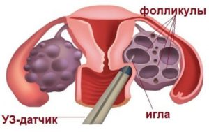 Биопсия яичников у женщин