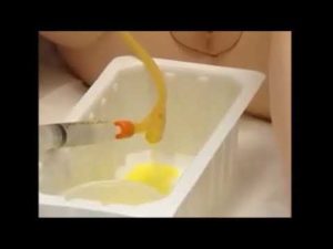 Как промывать катетер мочевой