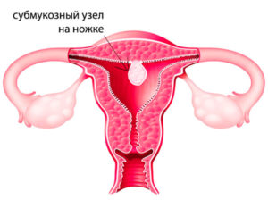 Особенности миомы матки на ножке