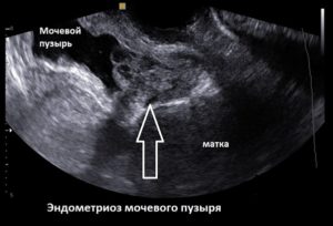 Симптомы эндометриоза мочевого пузыря у женщин