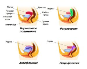 Антефлексия матки