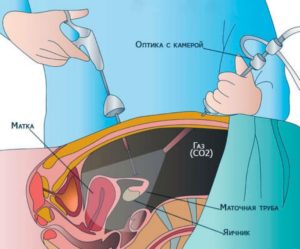 Лапароскопия матки