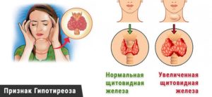 Симптомы гипотиреоза в менопаузе