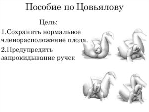Тазовое предлежание плода на 30 неделе беременности