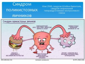 Техника диатермокаутеризация яичников при синдроме поликистозных яичников