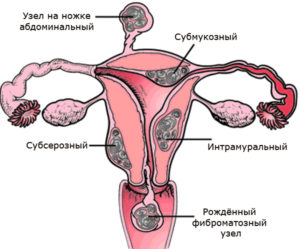 Перерождается ли миома матки в рак матки