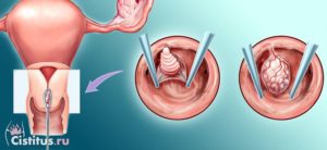 Полип в цервикальном канале шейки матки