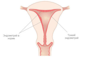 Причины тонкого эндометрия матки