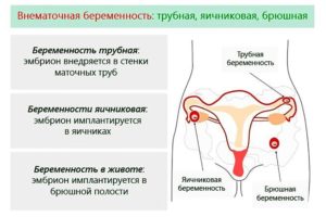 Что делать, если болят яичники при беременности на ранних сроках