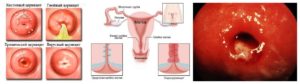 Что называют хроническим цервицитом шейки матки