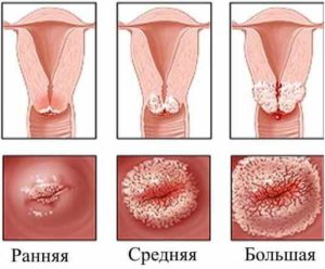 Бывает ли молочница у девственниц