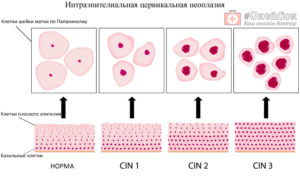 Легкая и тяжелая дисплазия шейки матки