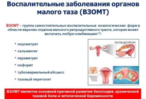 Симптомы воспаления органов малого таза у женщин