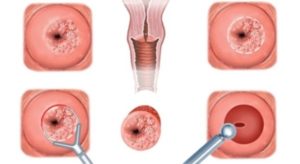 Последствия после диатермоконизации шейки матки