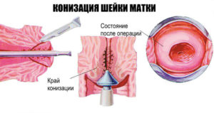 Как делают конизацию шейки матки