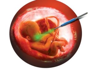Редукция эмбриона при многоплодной беременности