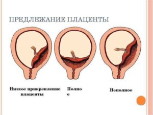 Низкое расположение матки