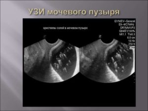 Как быстро наполнить мочевой пузырь перед узи