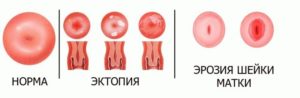 Что называют цервикальной эктопией шейки матки