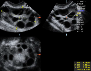 Мультикистоз яичников: лечение